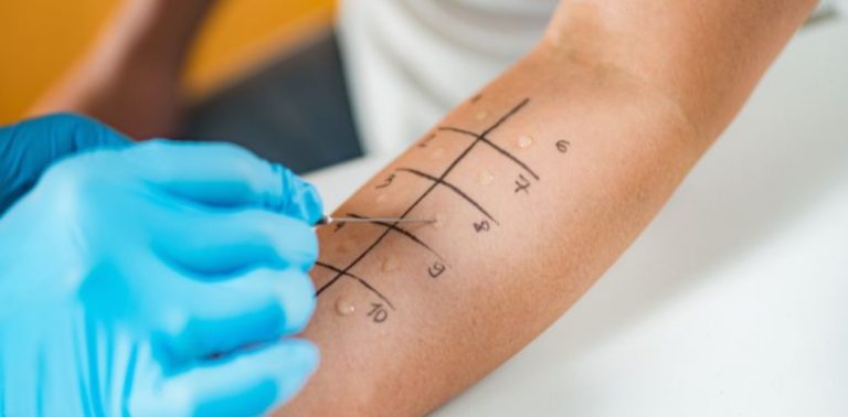 A patient having an allergy test done on their arm.