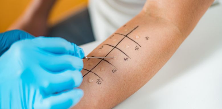 A patient having an allergy test done on their arm.