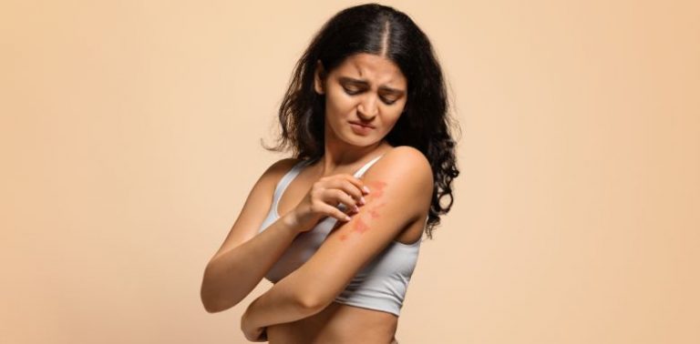 A woman scratching a psoriasis rash on her arm.