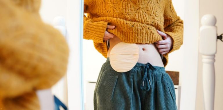 A woman looking at her ostomy bag in the mirror.